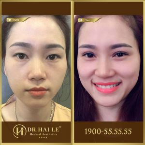 Hình ảnh cắt mí trước sau Dr Hải Lê - Ca 156