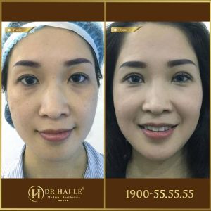 Hình ảnh cắt mí trước sau Dr Hải Lê - Ca 157