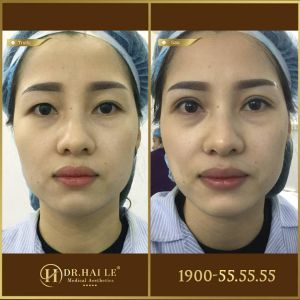 Hình ảnh cắt mí trước sau Dr Hải Lê - Ca 158