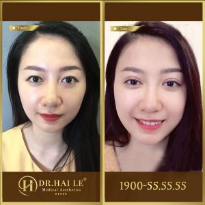 Hình ảnh cắt mí trước sau Dr Hải Lê - Ca 160