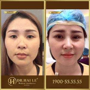 Hình ảnh cắt mí trước sau Dr Hải Lê - Ca 162