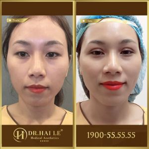 Hình ảnh cắt mí trước sau Dr Hải Lê - Ca 163