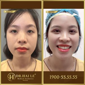Hình ảnh cắt mí trước sau Dr Hải Lê - Ca 164