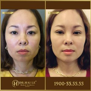 Hình ảnh cắt mí trước sau Dr Hải Lê - Ca 166