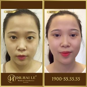 Hình ảnh cắt mí trước sau Dr Hải Lê - Ca 168