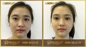 Hình ảnh cắt mí trước sau Dr Hải Lê - Ca 17