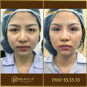 Hình ảnh cắt mí trước sau Dr Hải Lê - Ca 170