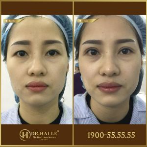 Hình ảnh cắt mí trước sau Dr Hải Lê - Ca 172