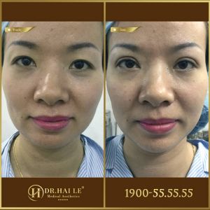 Hình ảnh cắt mí trước sau Dr Hải Lê - Ca 173