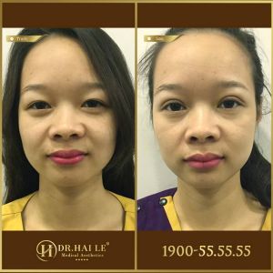 Hình ảnh cắt mí trước sau Dr Hải Lê - Ca 175