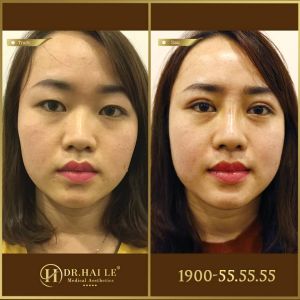 Hình ảnh cắt mí trước sau Dr Hải Lê - Ca 176
