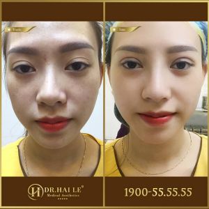 Hình ảnh cắt mí trước sau Dr Hải Lê - Ca 177