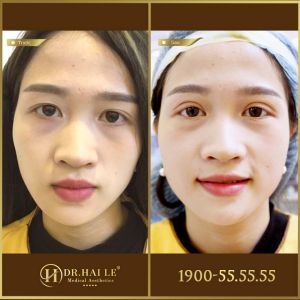 Hình ảnh cắt mí trước sau Dr Hải Lê - Ca 178