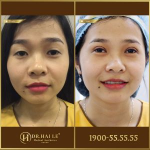 Hình ảnh cắt mí trước sau Dr Hải Lê - Ca 180