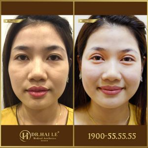 Hình ảnh cắt mí trước sau Dr Hải Lê - Ca 181