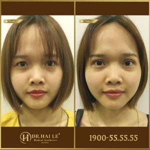 Hình ảnh cắt mí trước sau Dr Hải Lê - Ca 183