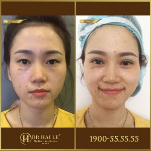 Hình ảnh cắt mí trước sau Dr Hải Lê - Ca 185