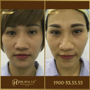 Hình ảnh cắt mí trước sau Dr Hải Lê - Ca 186