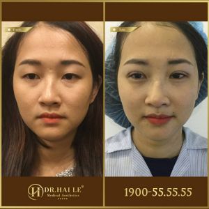 Hình ảnh cắt mí trước sau Dr Hải Lê - Ca 187
