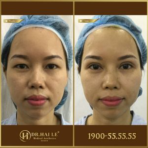 Hình ảnh cắt mí trước sau Dr Hải Lê - Ca 189