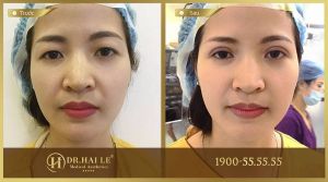 Hình ảnh cắt mí trước sau Dr Hải Lê - Ca 19