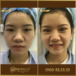 Hình ảnh cắt mí trước sau Dr Hải Lê - Ca 190