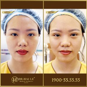 Hình ảnh cắt mí trước sau Dr Hải Lê - Ca 191