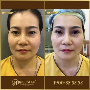 Hình ảnh cắt mí trước sau Dr Hải Lê - Ca 192