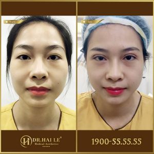 Hình ảnh cắt mí trước sau Dr Hải Lê - Ca 193