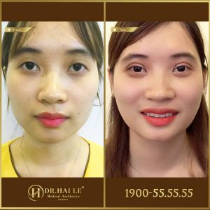 Hình ảnh cắt mí trước sau Dr Hải Lê - Ca 194