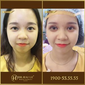Hình ảnh cắt mí trước sau Dr Hải Lê - Ca 196