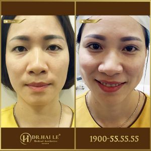 Hình ảnh cắt mí trước sau Dr Hải Lê - Ca 197