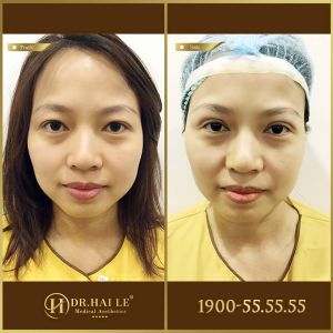 Hình ảnh cắt mí trước sau Dr Hải Lê - Ca 198