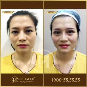 Hình ảnh cắt mí trước sau Dr Hải Lê - Ca 199