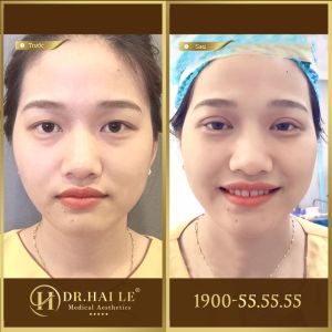 Hình ảnh cắt mí trước sau Dr Hải Lê - Ca 2