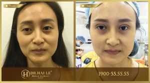 Hình ảnh cắt mí trước sau Dr Hải Lê - Ca 20
