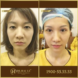 Hình ảnh cắt mí trước sau Dr Hải Lê - Ca 200