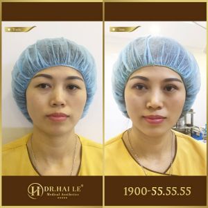Hình ảnh cắt mí trước sau Dr Hải Lê - Ca 201