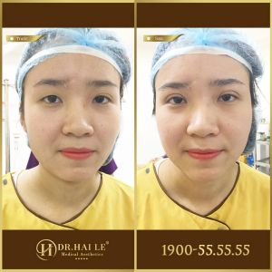 Hình ảnh cắt mí trước sau Dr Hải Lê - Ca 202