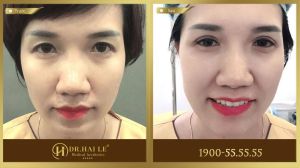 Hình ảnh cắt mí trước sau Dr Hải Lê - Ca 203