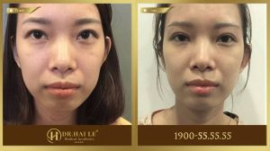 Hình ảnh cắt mí trước sau Dr Hải Lê - Ca 204