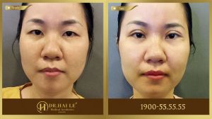Hình ảnh cắt mí trước sau Dr Hải Lê - Ca 205