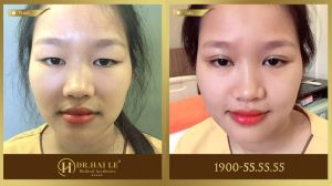 Hình ảnh cắt mí trước sau Dr Hải Lê - Ca 206