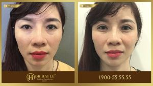 Hình ảnh cắt mí trước sau Dr Hải Lê - Ca 216
