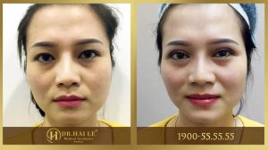 Hình ảnh cắt mí trước sau Dr Hải Lê - Ca 22