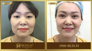 Hình ảnh cắt mí trước sau Dr Hải Lê - Ca 223