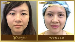 Hình ảnh cắt mí trước sau Dr Hải Lê - Ca 224