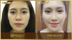 Hình ảnh cắt mí trước sau Dr Hải Lê - Ca 23