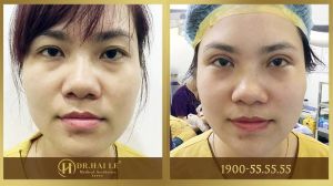 Hình ảnh cắt mí trước sau Dr Hải Lê - Ca 24