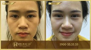 Hình ảnh cắt mí trước sau Dr Hải Lê - Ca 25
